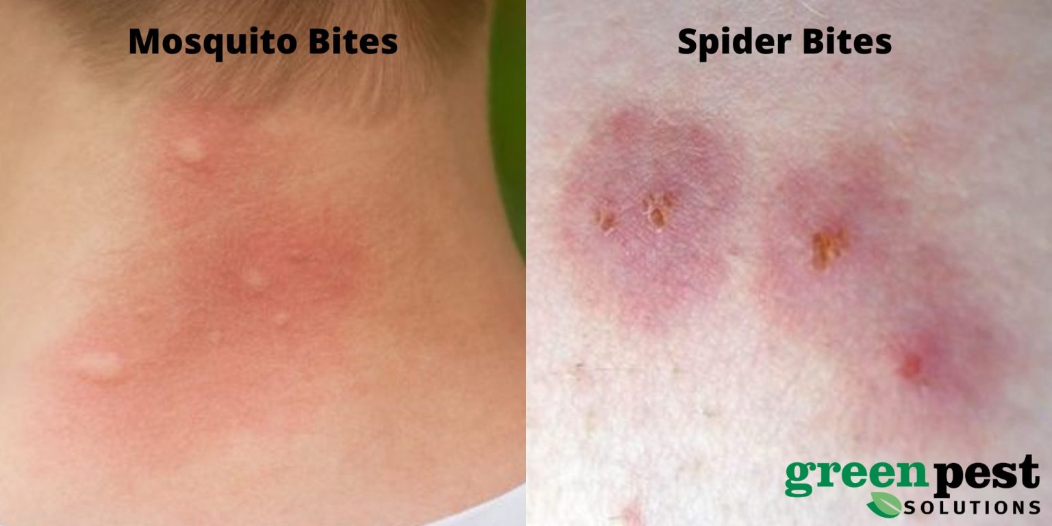 How To Tell A Spider Bite From A Mosquito Bite What To Look For In   How To Tell A Spider Bite From A Mosquito Bite96 1536x768 